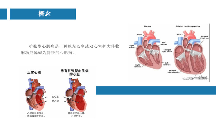 心肌擴(kuò)張中國最新療法揭秘，創(chuàng)新治療引領(lǐng)未來??